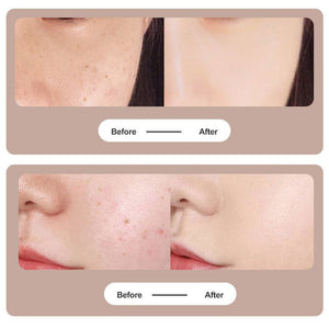 Tattoo Mole Removal Plasma Pen Laser Facial Freckle Dark Spot Remover